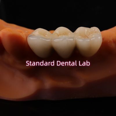 Αγορά Ψηφιακό CAD CAM Δοντιατρικά Εργαστηριακά Στέμματα Διαφανή Στέμματα Ζιρκόνια Στέμματα σε απευθείας σύνδεση κατασκευή