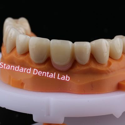 Ψηφιακό CAD CAM Στρίψιμο στρωμένο Zirconia Bridge Crown με ροζ πορσελάνη