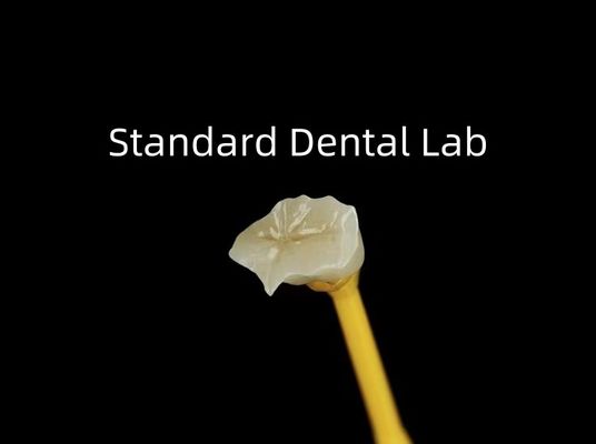 Οδοντιατρική πορσελάνη Inlay Onlay Zirconia Emax Υψηλή αισθητική