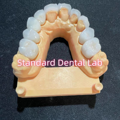 Υψηλή αισθητική Χόλιγουντ Smile Milling Emax λαμιναρισμένα ελαστικά