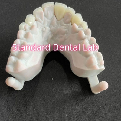 Τα δόντια των αστέρων Emax Zirconia Laminate Veneers 0,6mm