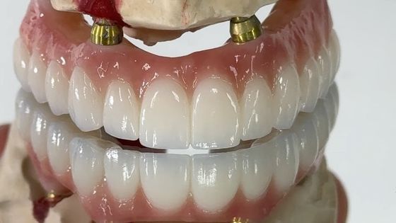 Οδοντιατρική ΟΛΟΣ ΟΝ X εμφύτευση PFM Crown Titanium Fixed Hybrid Denture
