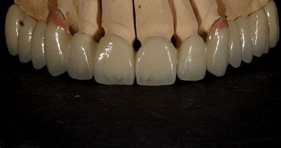 Καλή προσαρμογή Καλή αισθητική Πολυεπίπεδη Κρόνα Ζιρκόνια Πορσελάνη Γέφυρα Ζιρκόνια