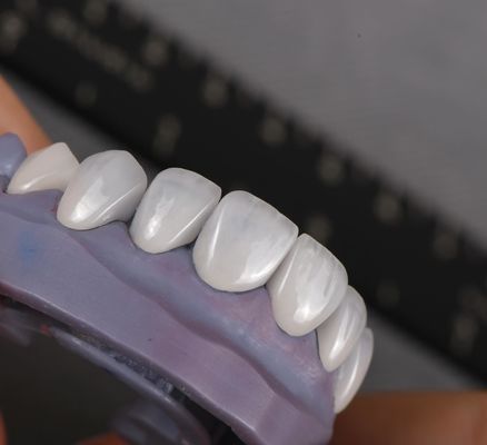 Φυσική εμφάνιση Emax Veneers Crown Biocompatibility Λευκαντική σκιά με ελάχιστη προετοιμασία