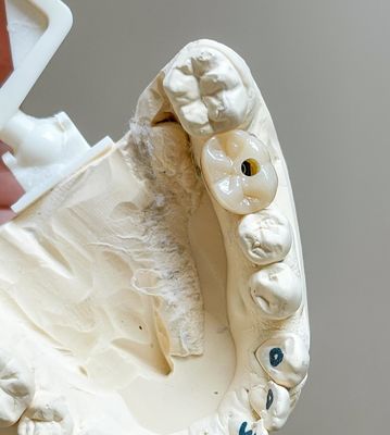 Στροφικό τσιμέντο διατηρημένο εμφύτευμα γυαλισμένα εμφύτευμα υποστηριζόμενη πορσελάνη γέφυρα πλήρης αψίδα