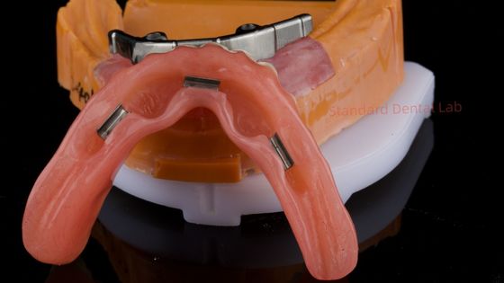 Ivoclar Ψηφιακό οδοντικό εμφύτευμα Τάχνη οδοντοστοιχίας με συνημμένα Πλήρης ακρυλική οδοντοστοιχία Τιτανίου οδοντοστοιχίες με στήριξη εμφύτευσης