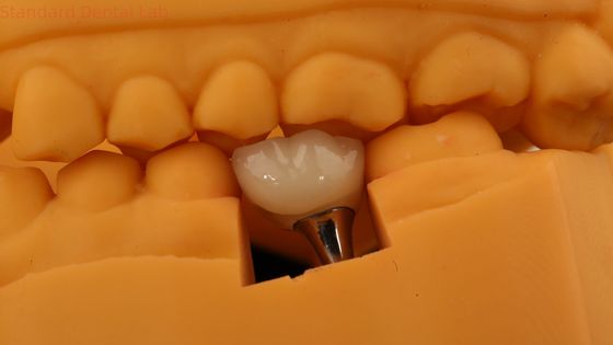 Κρόνος οδοντικών εμφυτευμάτων με βίδα με 3D εκτύπωση