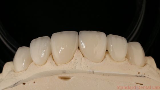 Ακριβής Zirconia Crown Bridge άνετη ρύθμιση / αισθητική 3-4 ημέρες γρήγορος χρόνος μεταφοράς