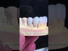 Φυσική εμφάνιση Emax Veneers Crown Biocompatibility Λευκαντική σκιά με ελάχιστη προετοιμασία
