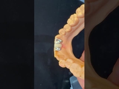 Οδοντιατρικά Δόντια PFM Maryland Bridge Υψηλή αισθητική Πιστοποιημένο από την FDA