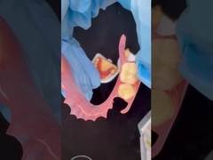 3D εκτύπωση μοντέλο υψηλής αισθητικής οδοντιατρική TCS Valplast ευέλικτες μερικές οδοντοστοιχίες οδοντιατρικό εργαστήριο